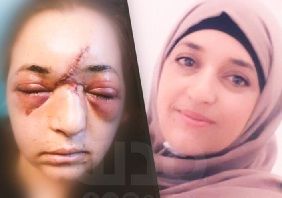 Police officer fractures Jerusalemite woman�s skull with rifle stock