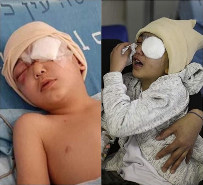 Palestinian child loses his eye in IOF shooting in Nablus