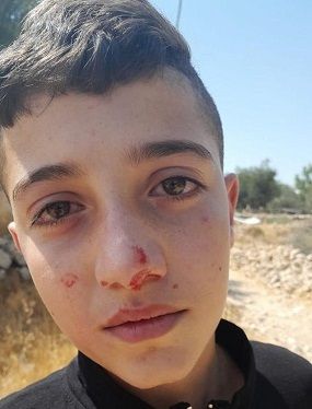 Palestinian child injured in settler attack in al-Khalil