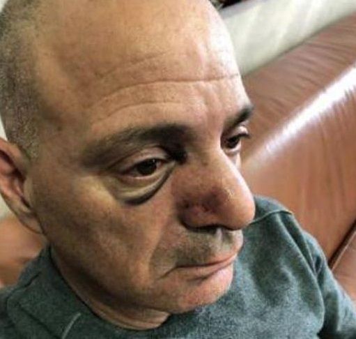 Palestinian injured in settler attack in Jerusalem