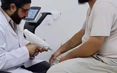 مخيم خان دنون. مبادرة إزالة الوشم تفتح باباً لخدمة مجتمعية